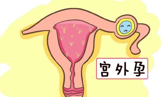 关于宫外孕的这些知识，女性一定要了解!