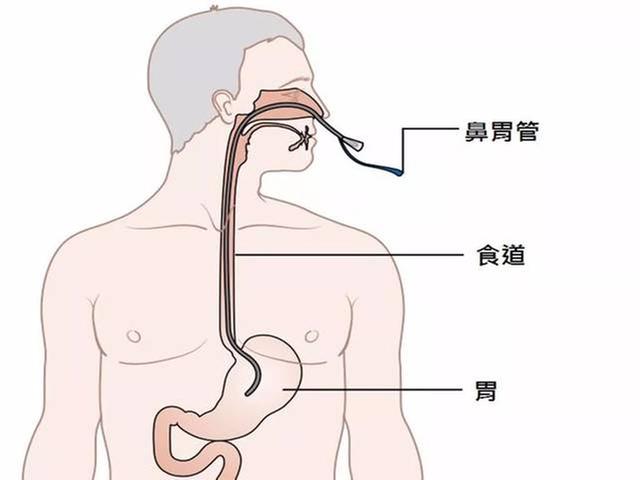 鼻胃管——进食困难患者的“生命通道”