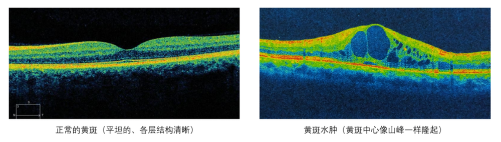 得个糖尿病还会引发“失明”？专家说：抓紧预防，不然没得后悔药给你吃！