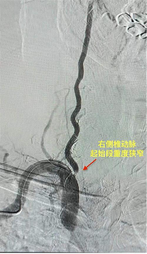 内江市市中区人民医院完成首例椎动脉狭窄支架植入术